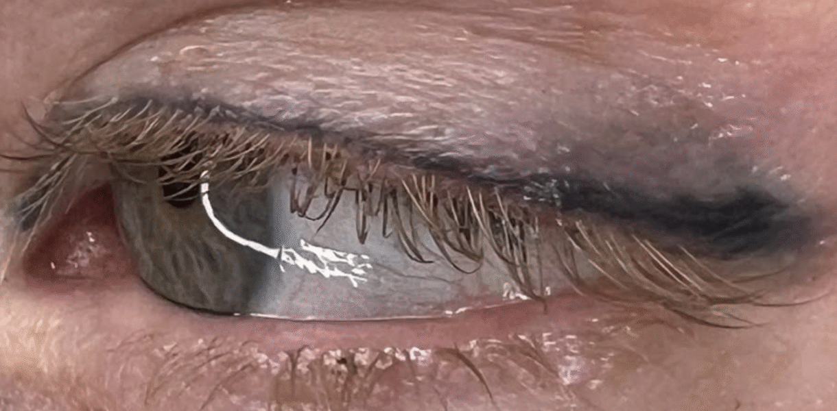 Can you do saline removal on eyeliner?