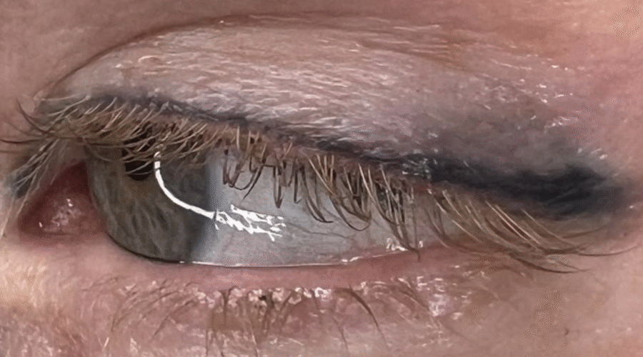 Can you do saline removal on eyeliner?