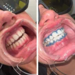 How Long Does a Teeth Whitening Course Take