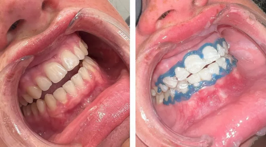 How Long Does a Teeth Whitening Course Take