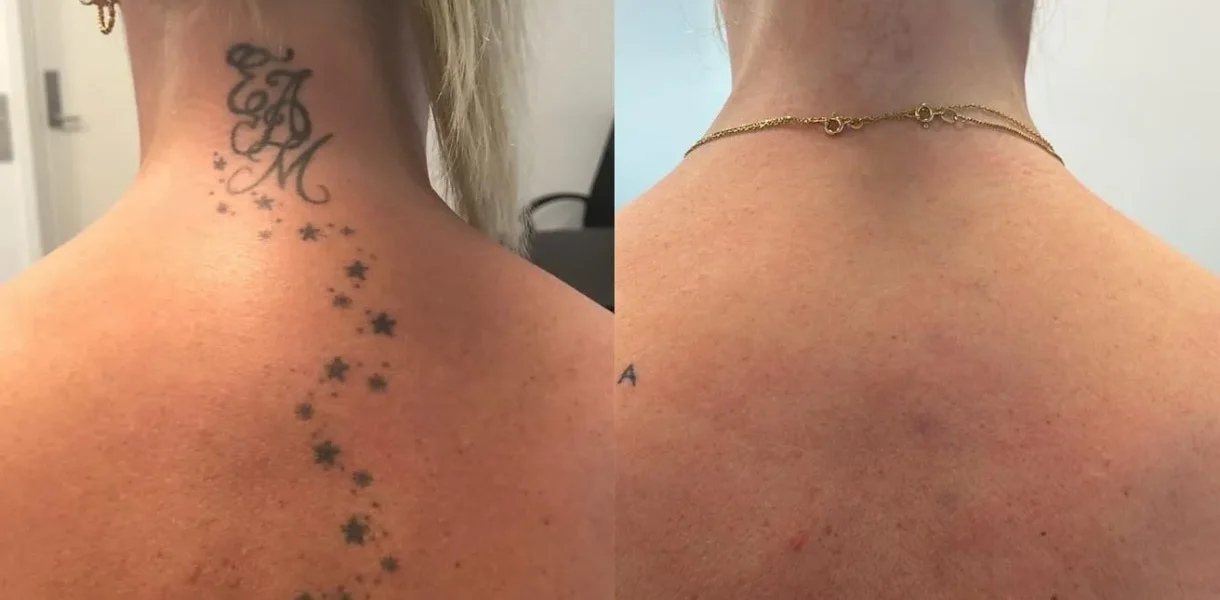What is the biggest concern with laser tattoo removal