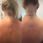 What is the biggest concern with laser tattoo removal