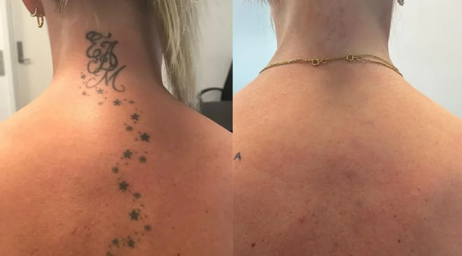 What is the biggest concern with laser tattoo removal